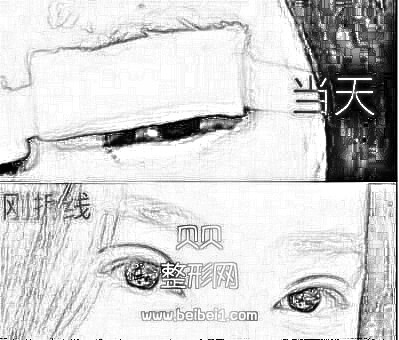 武汉同济医院王海平割双眼皮介绍分享~在线预约