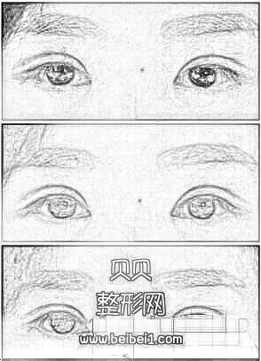 昆明延安医院做全切双眼皮+内眼角介绍 焦主任医生技术口碑好