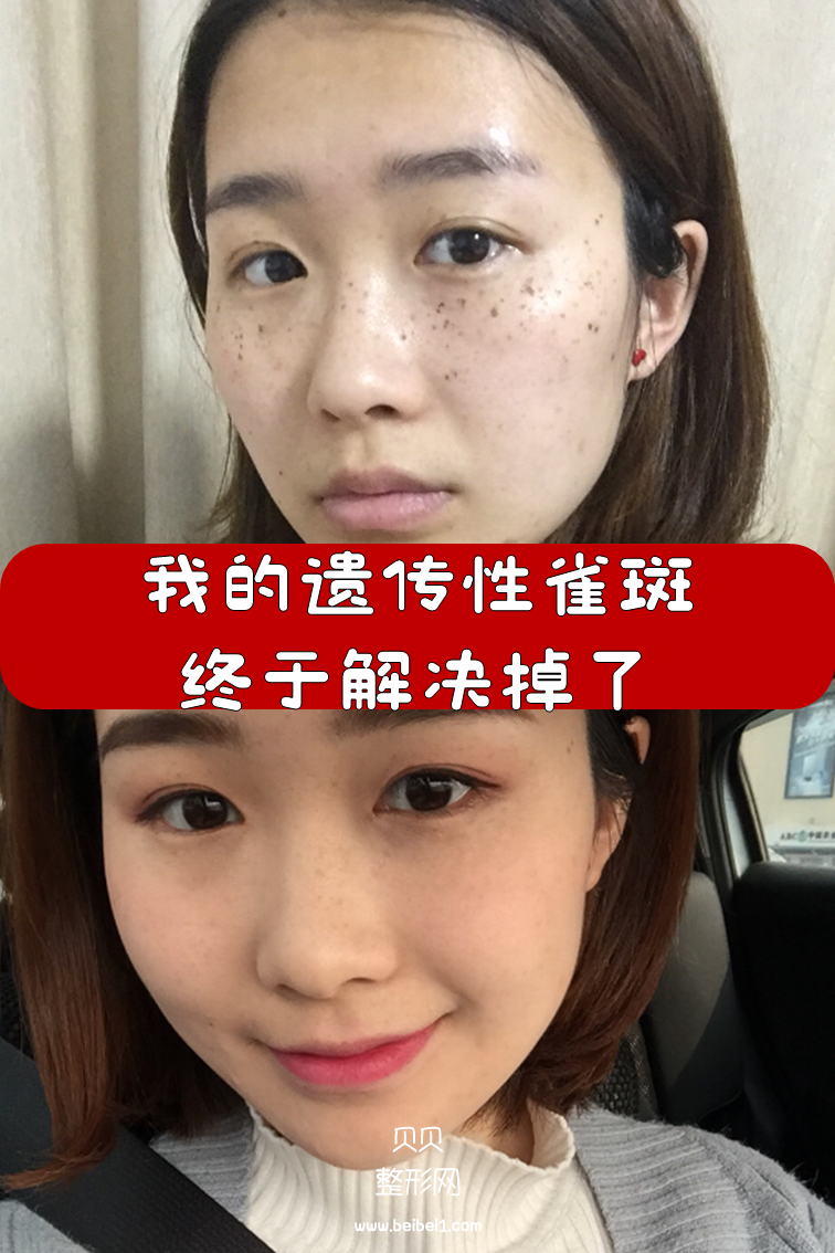 我的遗传性雀斑终于解决掉了,M22带头之心花了4500软妹币