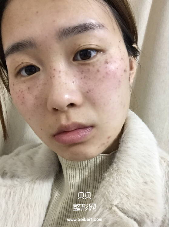 我的遗传性雀斑终于解决掉了,M22带头之心花了4500软妹币