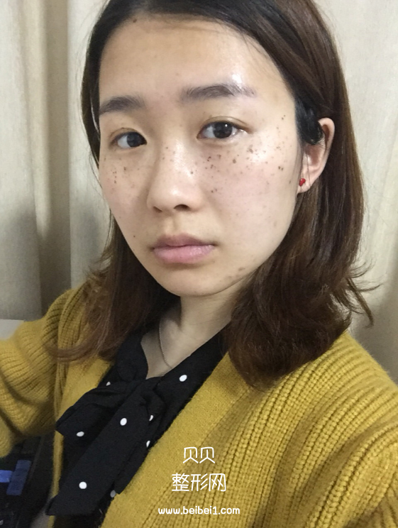 我的遗传性雀斑终于解决掉了,M22带头之心花了4500软妹币
