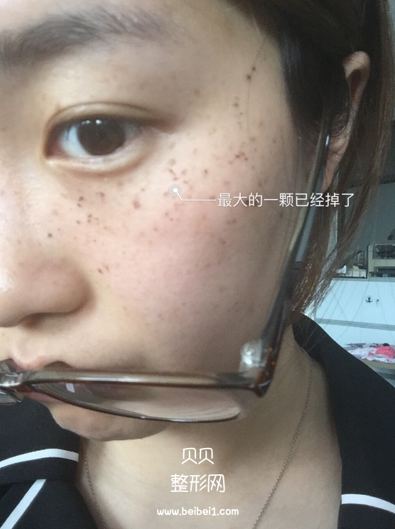 我的遗传性雀斑终于解决掉了,M22带头之心花了4500软妹币
