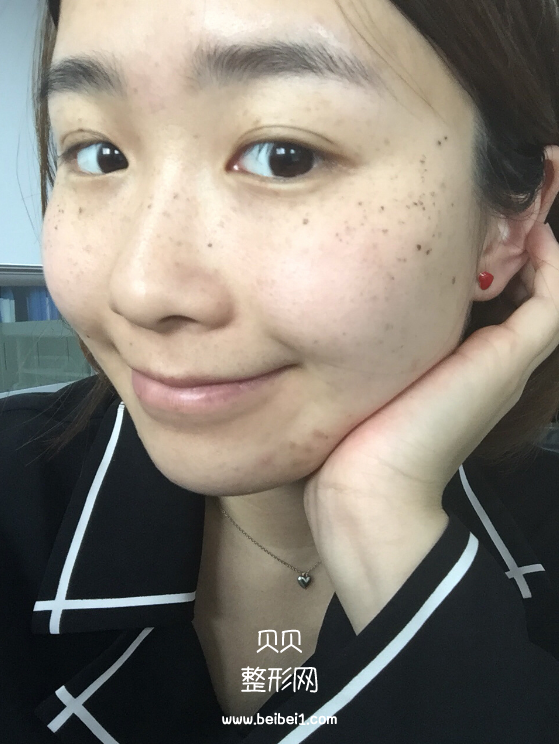 我的遗传性雀斑终于解决掉了,M22带头之心花了4500软妹币