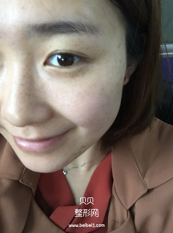我的遗传性雀斑终于解决掉了,M22带头之心花了4500软妹币