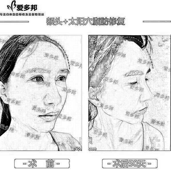 自体脂肪修复||小姐姐因为整形失败,丢了工作,不敢出门…