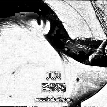 广州南方医院整形科陈其庆疤痕去除技术怎么样?介绍/分享