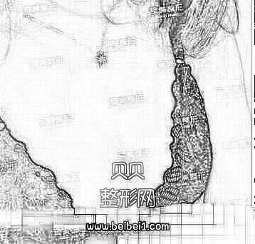 重庆军美医院做吸脂隆胸介绍 王青松医生技术杠杠的!在线预约