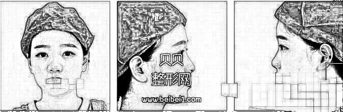 一百多天了，鼻子已经稳定了，直接给大家上图·上海玫瑰张东旭隆鼻果技术怎么样？介绍分享