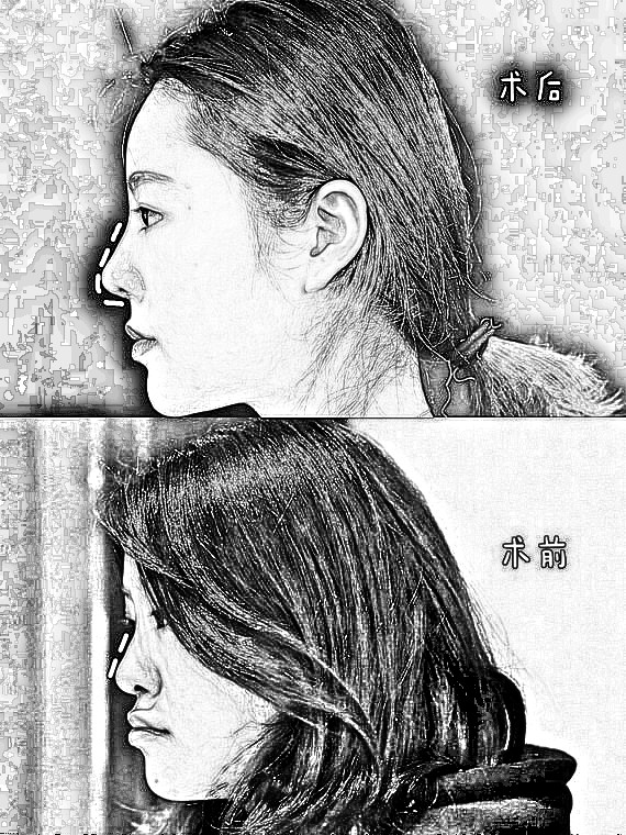 想隆鼻变美？千万不要跟风！这种原生鼻的基础不是特别好，原生鼻的高度不太够