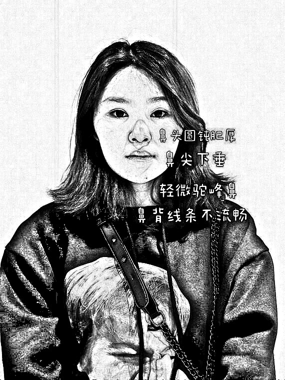 想隆鼻变美？千万不要跟风！这种原生鼻的基础不是特别好，原生鼻的高度不太够