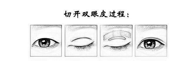 割双眼皮手术果怎么样?让五官越来越漂亮