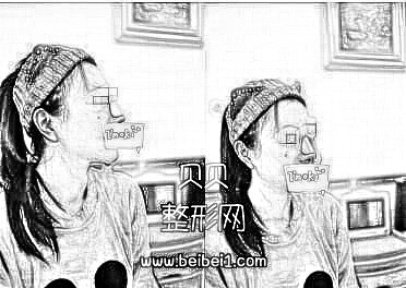 现在的侧面形态特别喜欢,鼻头翘翘的·成都艺星整形自体软骨隆鼻介绍分享