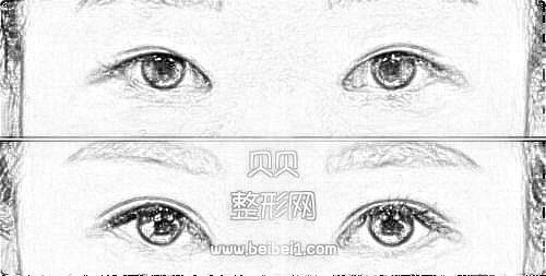 沈阳杏林整形医院张莹莹双眼皮果好吗?多少钱?介绍分享