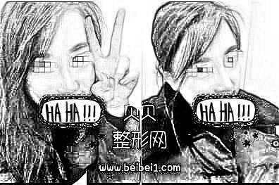 现在的侧面形态特别喜欢,鼻头翘翘的·成都艺星整形自体软骨隆鼻介绍分享