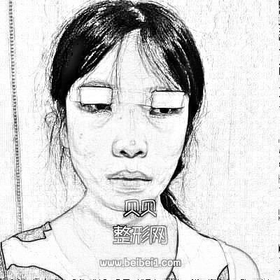 (眼部修复史)重庆美禅吴一双眼皮修复介绍展示