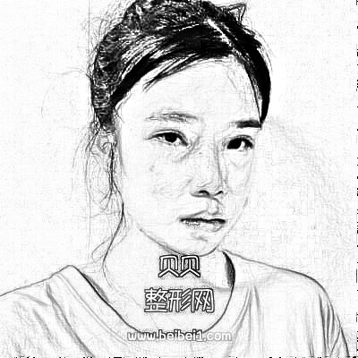 (眼部修复史)重庆美禅吴一双眼皮修复介绍展示