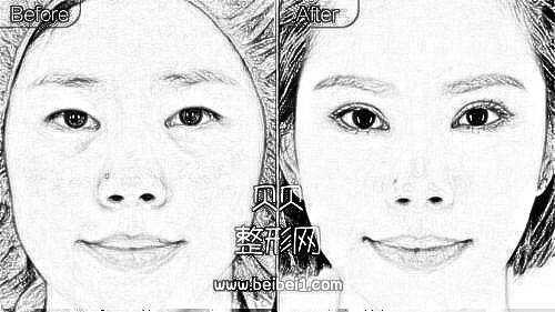 西安交大一附院整形科舒茂国割双眼皮和隆鼻怎么样？多少钱？
