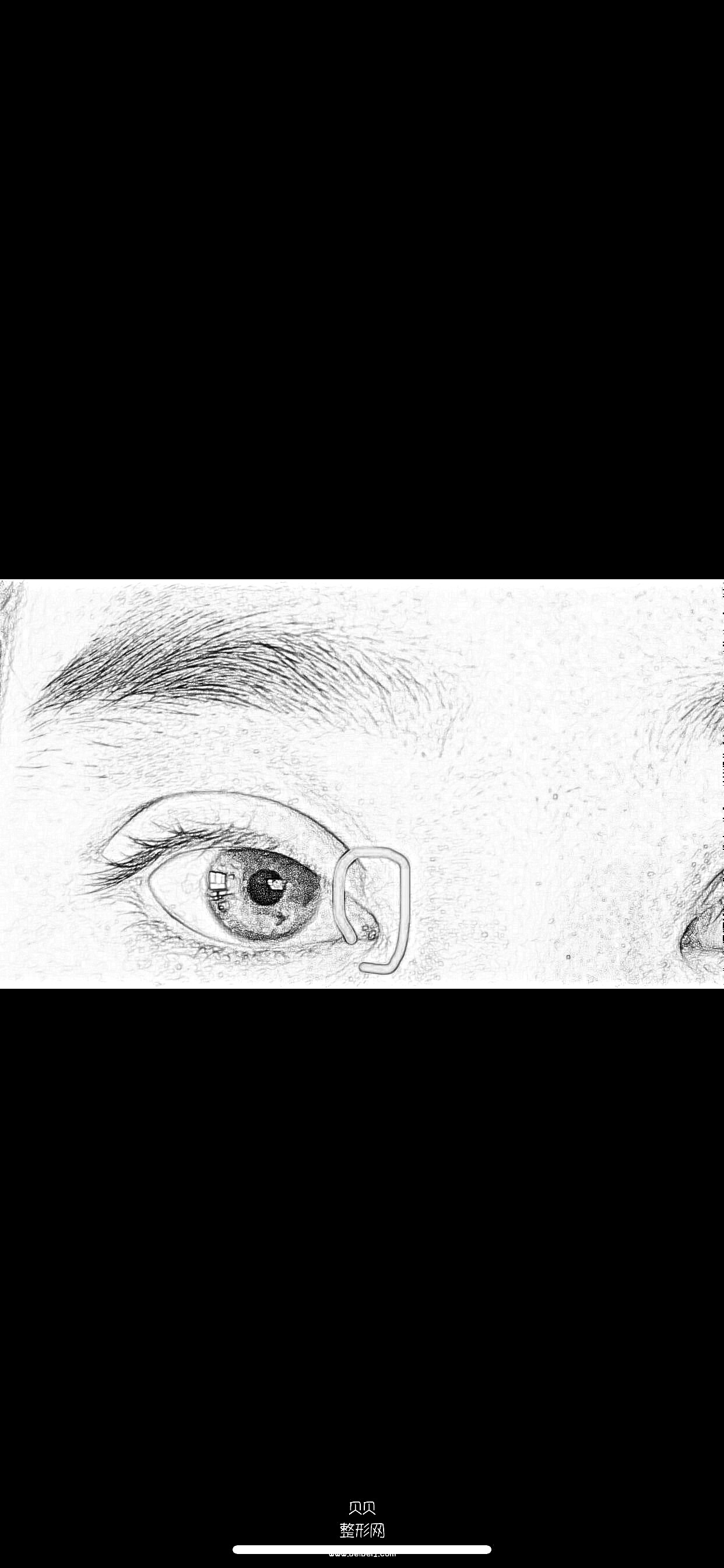 全切双眼皮➕开眼角半个月了 右眼睛眼角看着像多一块小肉一样