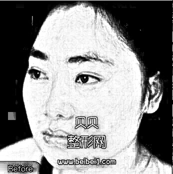 面部抽脂介绍果，3个月瘦脸成功！沈阳和平百嘉丽整形医院面部吸脂介绍分享