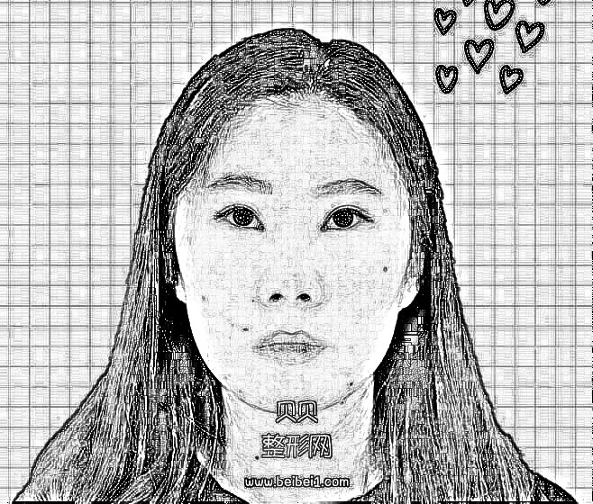 天津伊美尔外切去眼袋手术果术后3个月介绍反馈，美美哒！做完像像5年前的自己一样