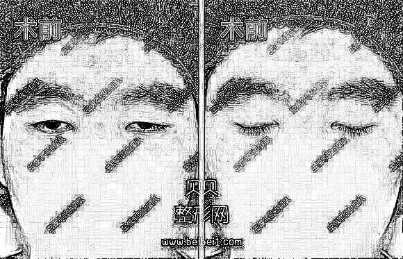 上睑下垂矫正术后果介绍分享