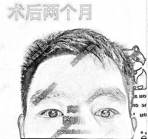 上睑下垂矫正术后果介绍分享