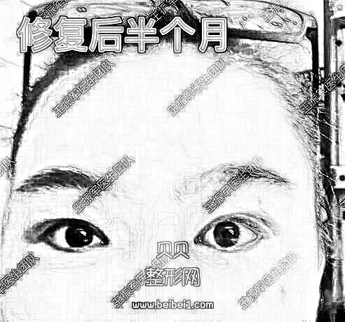 修复术后半个月