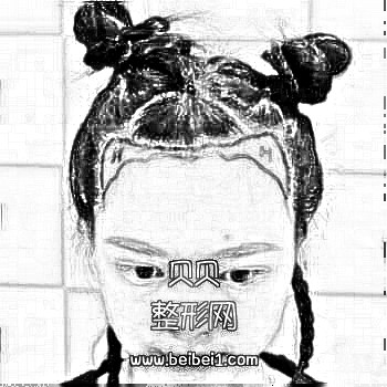 深圳雍禾植发医院收费标准以及介绍分享，头顶浓密的头发已经经历了三个月的脱发