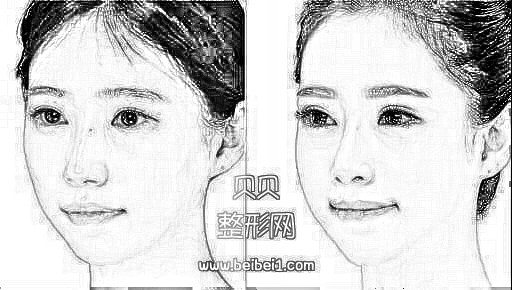 西安交大一附院整形科舒茂国割双眼皮和隆鼻多少钱?