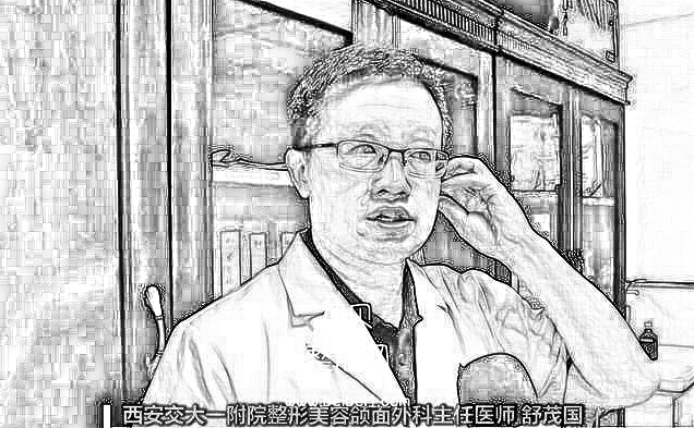 西安交大一附院整形科舒茂国割双眼皮和隆鼻好吗?果怎么样?