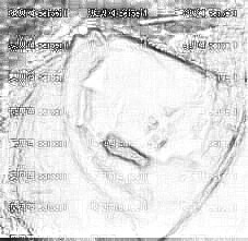 上海五官科医院张天宇耳部再造手术介绍片分享·有了新的耳朵之后,对于人生又充满了希望