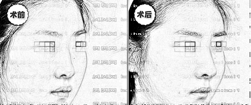 西南医院隆鼻手术价格大概多少钱?哪个医生技术好?【介绍】