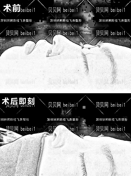 陈桂飞做鼻子技术怎么样？擅长什么样的手术方式？