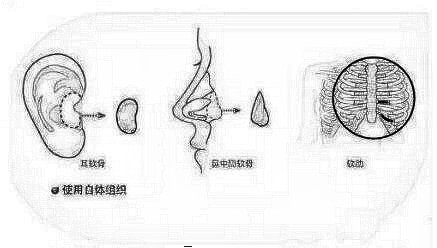 深圳yestar艺星的潘华医生个人简介，隆鼻口碑介绍评价分享！