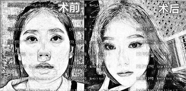 深圳南雅张颖杰【面部吸脂】价格:¥29800 介绍果怎么样?