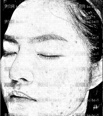 北京做的果酸焕肤98天了 痘印已经淡了很多，皮肤也比原来白皙细腻了