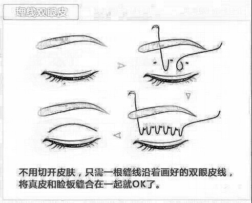 为什么很多人都喜欢选择埋线双眼皮手术?