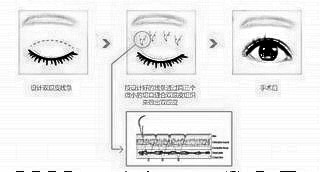 埋线双眼皮多久恢复，埋线双眼皮价格是多少？