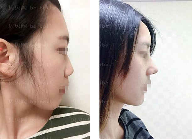 北京煤炭总医院隆鼻王驰和王英勇哪个好？谁的介绍好看