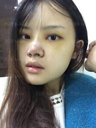 北京煤炭总医院整形科王英勇技术隆鼻怎么样?介绍好看吗?