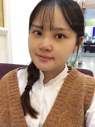 北京煤炭总医院整形科王英勇技术隆鼻怎么样?介绍好看吗?