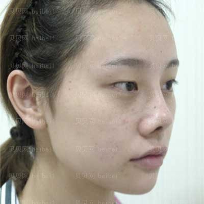 清华玉泉整形医院隆鼻技术怎么样?哪位医生好?