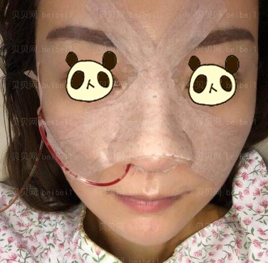 中日友好医院薛志强案隆鼻例图好看吗?技术怎么样?手术风格是偏自然的吗?