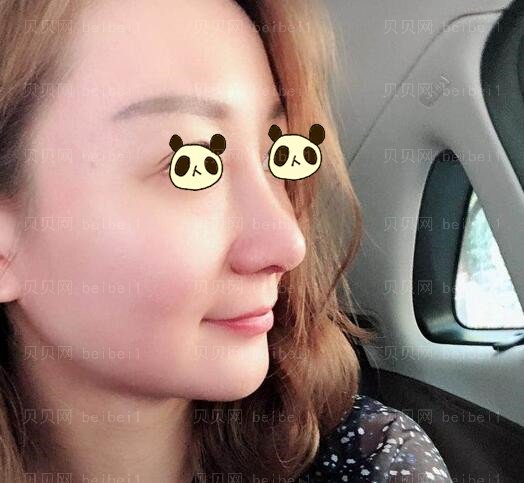 中日友好医院薛志强案隆鼻例图好看吗?技术怎么样?手术风格是偏自然的吗?