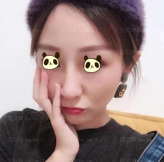 中日友好医院薛志强案隆鼻例图好看吗?技术怎么样?手术风格是偏自然的吗?