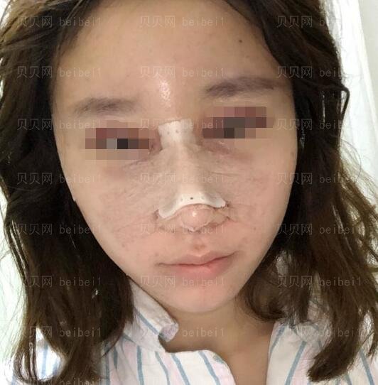 广州南方医院整形科隆鼻哪个医生好?罗勇技术怎么样?
