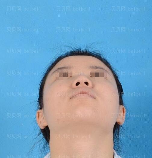 广州南方医院整形科隆鼻哪个医生好?罗勇技术怎么样?