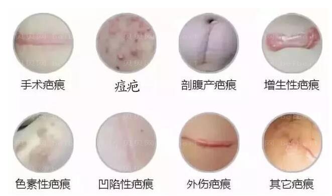 深圳鹏程医院疤痕技术怎么样?全新调节技术及介绍分享!