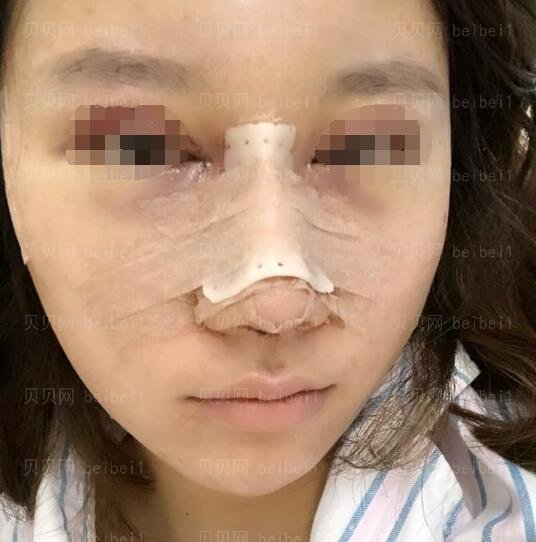 广州南方医院整形科隆鼻哪个医生好？罗勇技术怎么样？