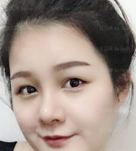 贵州省人民医院隆鼻手术介绍果怎么样?